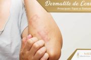 Dermatite de Contato