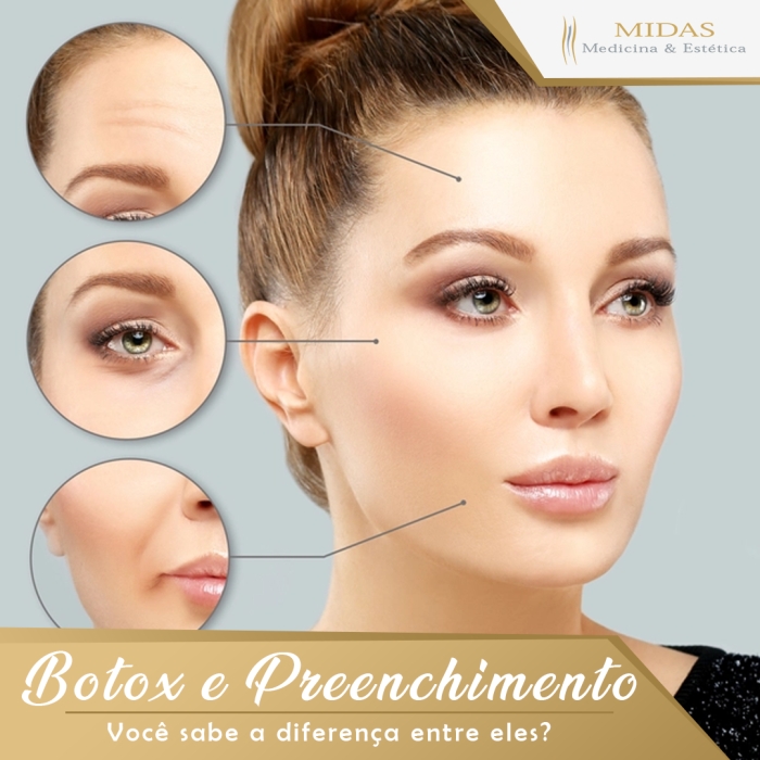 Botox E Preenchimento Você Sabe A Diferença Entre Eles Midas Medicina And Estética No Centro Rj 