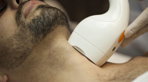 Dúvidas mais frequentes sobre depilação a laser de barba