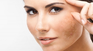 Manchas na pele? Conheça os tratamentos para combater o melasma